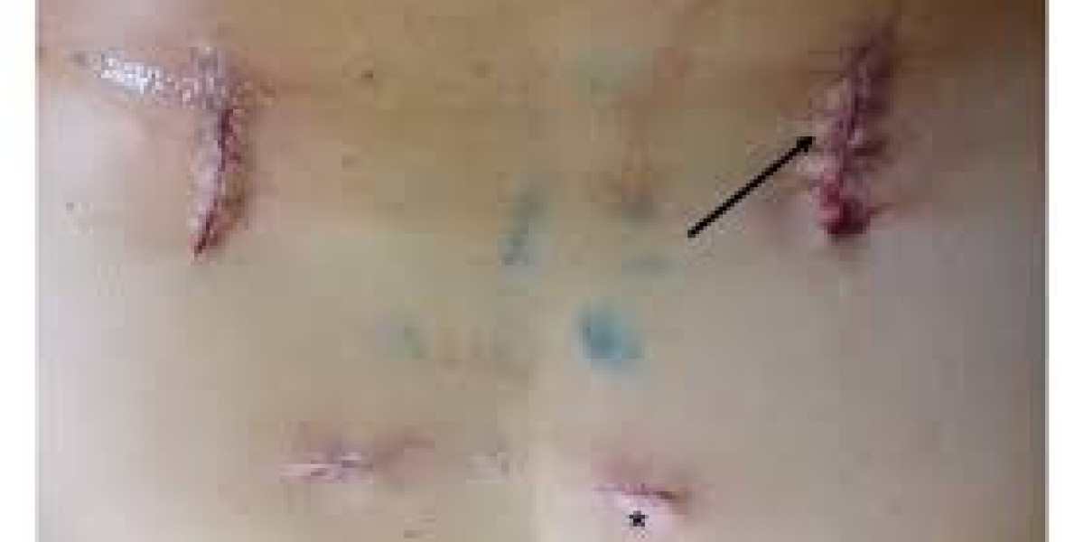 Non-invasive Surgical Wound Closure Market Emerging Applications And Regional Analysis Outlook