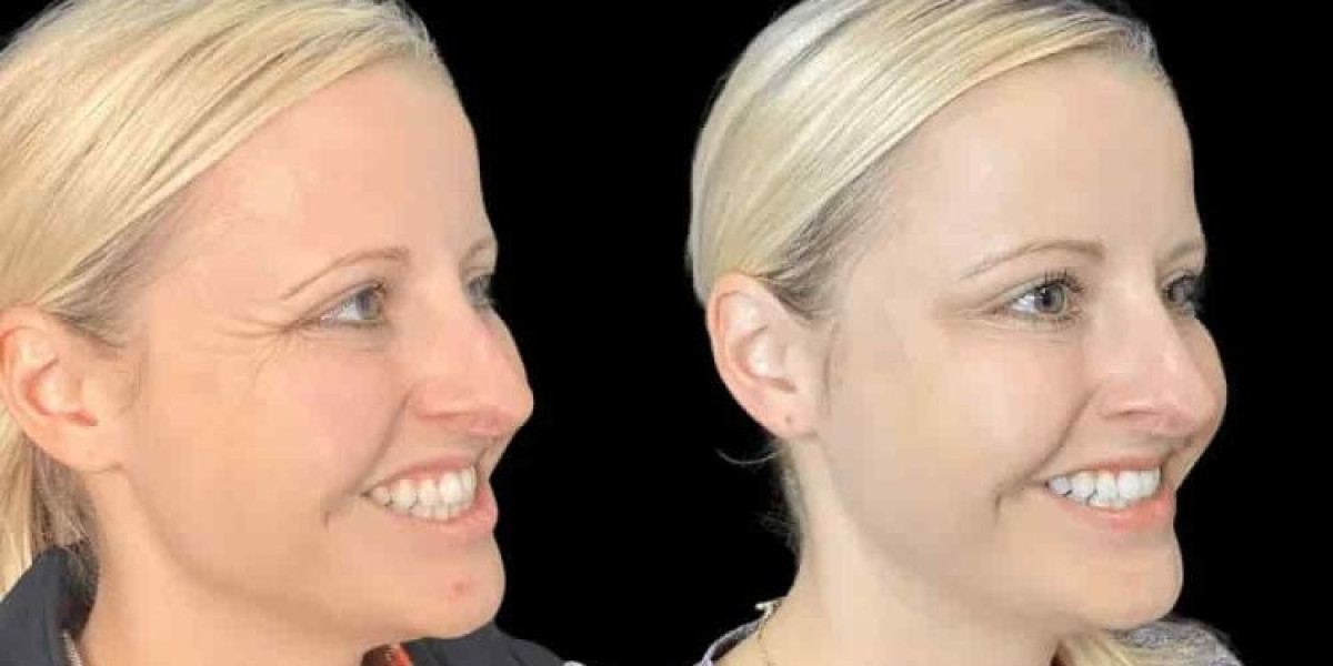 Best Plastic Surgeons in Dubai for Botox for Fine Lines and Wrinkles